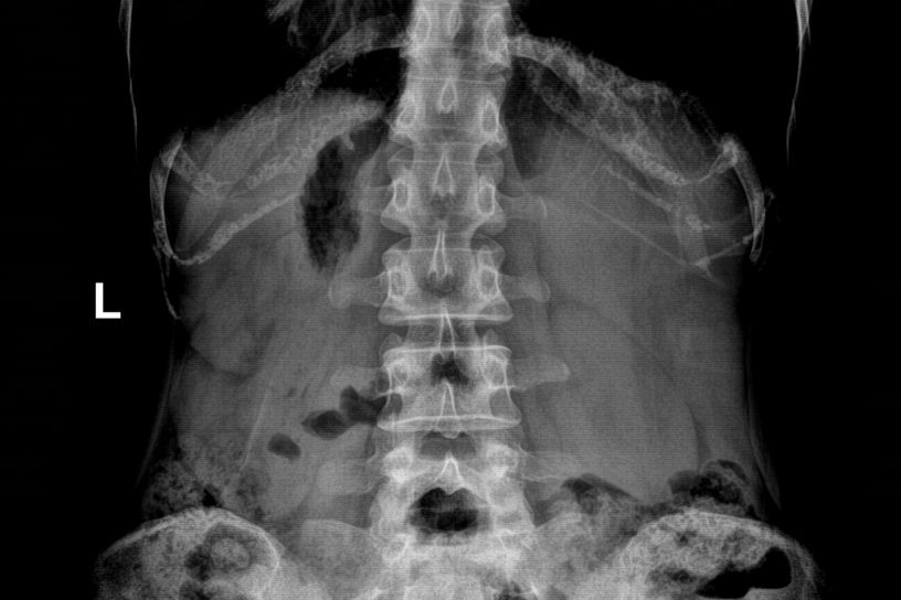 kỹ thuật chụp x-quang ổ bụng
